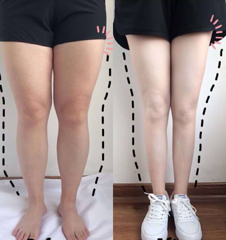 건강 개선 사례